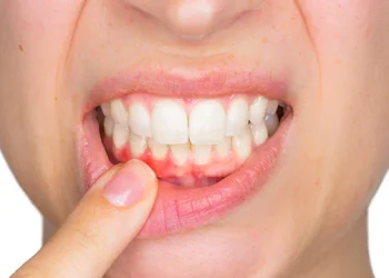 Salud bucal: qué se debe tener en cuenta para el cuidado de las encías