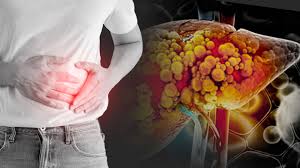 Cinco hábitos cotidianos que pueden dañar al hígado sin causar síntomas evidentes