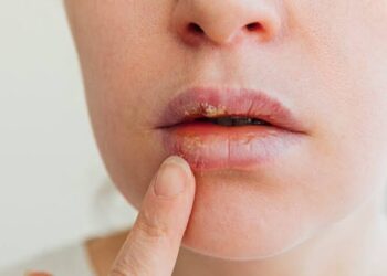 Labios agrietados y doloridos: Los hábitos comunes que empeoran su estado