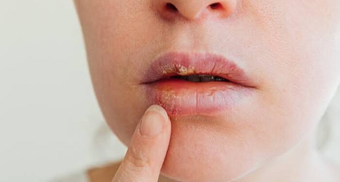 Labios agrietados y doloridos: Los hábitos comunes que empeoran su estado