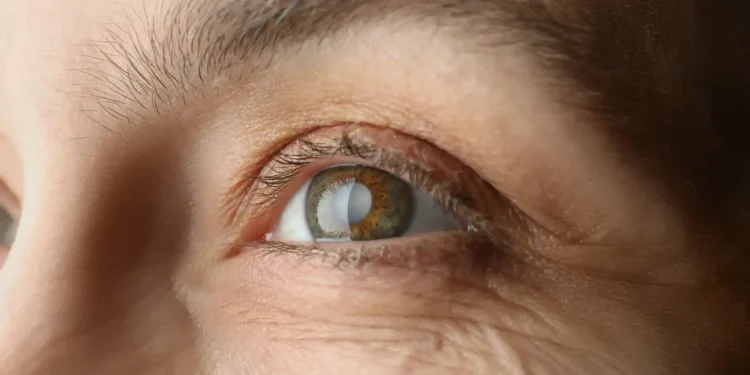 Cataratas: cuáles son los síntomas, los factores de riesgo y cuándo se evalúa una cirugía